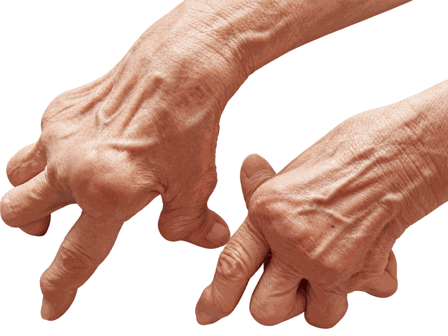 An older person's hands with swollen knuckles and bent fingers, typical of rheumatoid arthritis