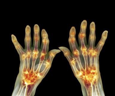 Coloured X-ray of both hands with inflamed joints highlighted, as seen in rheumatoid arthritis